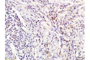 Formalin-fixed and paraffin embedded human colon carcinoma labeled with Rabbit Anti NGAL/Lipocalin 2 Polyclonal Antibody, Unconjugated (ABIN685627) at 1:200 followed by conjugation to the secondary antibody and DAB staining