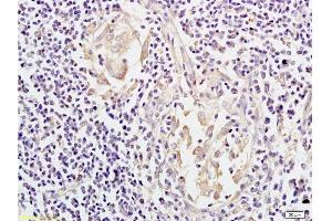 Formalin-fixed and paraffin embedded: human colon carcinoma labeled with Anti-Mesothelin Polyclonal Antibody, Unconjugated  at 1:200, followed by conjugation to the secondary antibody and DAB staining (Mesothelin Antikörper  (AA 101-200))