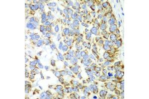 Immunohistochemistry of paraffin-embedded human esophageal cancer using CHIA antibody.