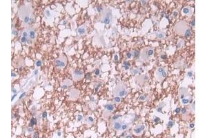 Detection of TDH in Human Glioma Tissue using Polyclonal Antibody to L-Threonine Dehydrogenase (TDH) (Tdh Antikörper  (AA 1-229))