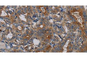 Immunohistochemistry of paraffin-embedded Human thyroid cancer tissue using PER2 Polyclonal Antibody at dilution 1:50 (PER2 Antikörper)