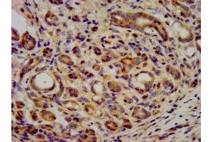 IHC image of ABIN7157616 diluted at 1:400 and staining in paraffin-embedded human pancreatic cancer performed on a Leica BondTM system. (KIF2B Antikörper  (AA 1607-1731))