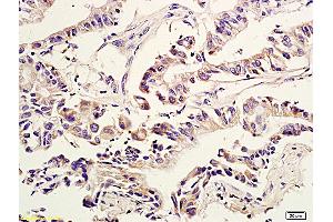 Formalin-fixed and paraffin embedded human colon cancer labeled with Anti Amphiregulin Polyclonal Antibody, Unconjugated (ABIN704996) at 1:600 followed by conjugation to the secondary antibody and DAB staining (Amphiregulin Antikörper  (AA 185-252))