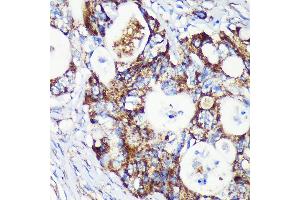 Immunohistochemistry of paraffin-embedded Human colon carcinoma using T Rabbit pAb (ABIN7266436) at dilution of 1:100 (40x lens).