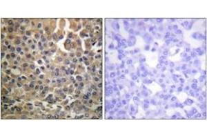 Immunohistochemistry analysis of paraffin-embedded human breast carcinoma, using HER4 (Phospho-Tyr1284) Antibody. (ERBB4 Antikörper  (pTyr1284))