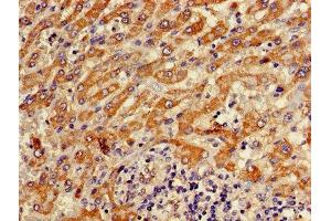 Immunohistochemistry of paraffin-embedded human liver cancer using ABIN7144848 at dilution of 1:100 (ATP5F1D Antikörper  (AA 23-168))