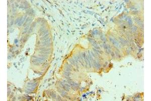 Immunohistochemistry of paraffin-embedded human colon cancer using ABIN7147105 at dilution of 1:100 (CNOT8 Antikörper  (AA 1-292))
