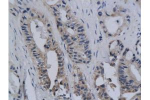Immunohistochemistry (Paraffin-embedded Sections) (IHC (p)) image for anti-C-Ros Oncogene 1 , Receptor tyrosine Kinase (ROS1) (AA 2231-2347) antibody (ABIN741225)