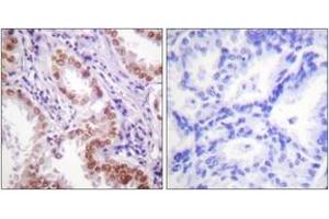 Immunohistochemistry analysis of paraffin-embedded human lung carcinoma tissue, using Histone H3 (Ab-9) Antibody. (Histone 3 Antikörper  (AA 1-50))