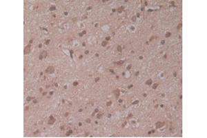 IHC-P analysis of Human Glioma Tissue, with DAB staining. (ENPP2 Antikörper  (AA 637-905))