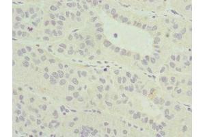 Immunohistochemistry of paraffin-embedded human liver cancer using ABIN7165022 at dilution of 1:100