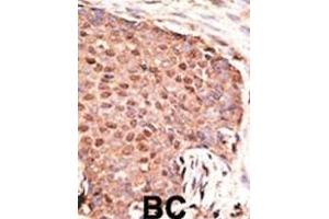 Formalin-fixed and paraffin-embedded human cancer tissue reacted with the primary antibody, which was peroxidase-conjugated to the secondary antibody, followed by AEC staining. (ZMIZ1 Antikörper  (C-Term))