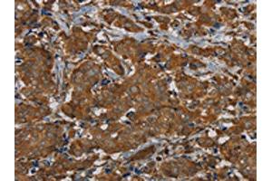 The image on the left is immunohistochemistry of paraffin-embedded Human breast cancer tissue using ABIN7191878(PIK3CD Antibody) at dilution 1/20, on the right is treated with synthetic peptide. (PIK3CD Antikörper)
