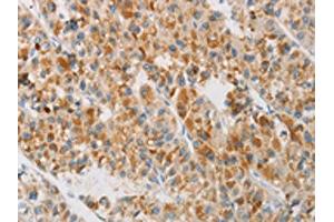 The image on the left is immunohistochemistry of paraffin-embedded Human liver cancer tissue using ABIN7130419(NGB Antibody) at dilution 1/20, on the right is treated with fusion protein. (Neuroglobin Antikörper)