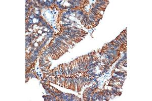Immunohistochemistry of paraffin-embedded human colon carcinoma using GP Rabbit mAb (ABIN1682863, ABIN3017875, ABIN3017876 and ABIN7101532) at dilution of 1:100 (40x lens). (GPA33 Antikörper)
