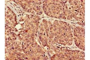 Immunohistochemistry of paraffin-embedded human ovarian cancer using ABIN7164854 at dilution of 1:100 (PTGER3 Antikörper  (AA 1-49))
