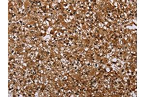 The image on the left is immunohistochemistry of paraffin-embedded Human prostate cancer tissue using ABIN7191451(MFF Antibody) at dilution 1/25, on the right is treated with synthetic peptide. (MFF Antikörper)