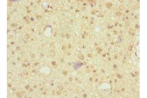 Immunohistochemistry of paraffin-embedded human glioma using ABIN7161221 at dilution of 1:100 (Neurexin 3 Antikörper  (AA 1584-1643))