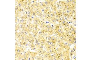 Immunohistochemistry of paraffin-embedded human liver injury using WT1 antibody at dilution of 1:100 (x400 lens). (WT1 Antikörper)