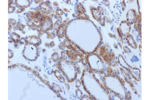 Formalin-fixed, paraffin-embedded human Thyroid Carcinoma stained with TSHRB Monoclonal Antibody (TSHRB/1405). (TSH receptor Antikörper)