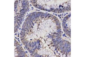 Immunohistochemistry of paraffin-embedded human rectal cancer using NPPA antibody at dilution of 1:200 (x400 lens). (NPPA Antikörper  (AA 26-151))