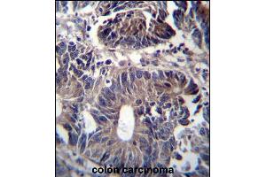 ZFYVE19 Antibody (C-term) (ABIN656951 and ABIN2846138) immunohistochemistry analysis in formalin fixed and paraffin embedded human colon carcinoma followed by peroxidase conjugation of the secondary antibody and DAB staining. (ZFYVE19 Antikörper  (C-Term))