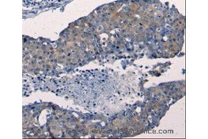 Immunohistochemistry of Human breast cancer using FGF2 Polyclonal Antibody at dilution of 1:50 (FGF2 Antikörper)