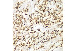Immunohistochemistry of paraffin-embedded human kidney cancer using SMAD9 antibody (ABIN5975592) at dilution of 1/100 (40x lens). (SMAD9 Antikörper)