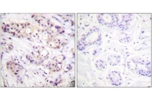 Immunohistochemistry analysis of paraffin-embedded human breast carcinoma tissue, using PKC alpha (Ab-638) Antibody. (PKC alpha Antikörper  (AA 606-655))