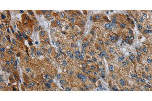 Immunohistochemistry of paraffin-embedded Human liver cancer using PDSS2 Polyclonal Antibody at dilution of 1:30 (PDSS2 Antikörper)