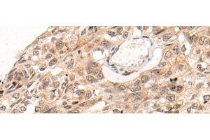Immunohistochemistry of paraffin-embedded Human esophagus cancer tissue using KNOP1 Polyclonal Antibody at dilution of 1:85(x200) (KNOP1 Antikörper)