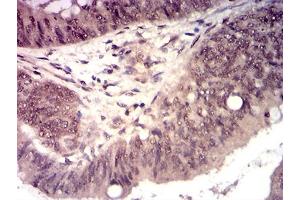 Immunohistochemical analysis of paraffin-embedded esophageal cancer tissues using HTRA2 mouse mAb with DAB staining. (HTRA2 Antikörper  (AA 278-458))