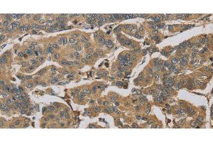 Immunohistochemistry of paraffin-embedded Human breast cancer tissue using TBXAS1 Polyclonal Antibody at dilution 1:30 (TBXAS1 Antikörper)