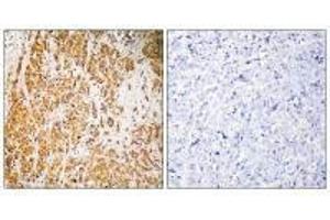 Immunohistochemistry analysis of paraffin-embedded human breast carcinoma tissue, using ZSCAN22 antibody. (ZSCAN22 Antikörper)