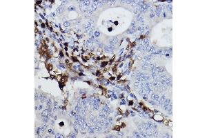 Immunohistochemistry of paraffin-embedded human colon carcinoma using NCF4/p40-phox Rabbit mAb (ABIN7268900) at dilution of 1:100 (40x lens). (NCF4 Antikörper)