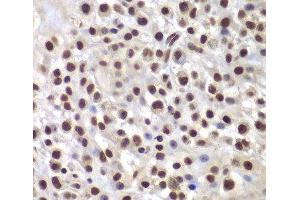 Immunohistochemistry of paraffin-embedded Mouse osteosarcoma using SMARCB1 Polyclonal Antibody at dilution of 1:200 (40x lens). (SMARCB1 Antikörper)