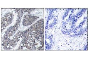 Immunohistochemical analysis of paraffin-embedded human breast carcinoma tissue, using Pyk2 (Ab-402) antibody (E021209). (PTK2B Antikörper)