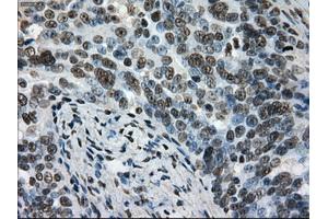 Immunohistochemical staining of paraffin-embedded Adenocarcinoma of colon tissue using anti-L1CAMmouse monoclonal antibody. (L1CAM Antikörper)