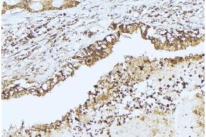 ABIN6275349 at 1/100 staining Human lung cancer tissue by IHC-P. (PEX14 Antikörper  (Internal Region))