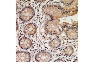 Immunohistochemical analysis of STEAP2 staining in human colon cancer formalin fixed paraffin embedded tissue section. (STEAP2 Antikörper  (C-Term))