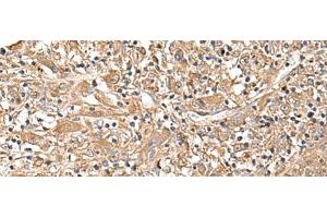 Immunohistochemistry of paraffin-embedded Human liver cancer tissue using LEPR Polyclonal Antibody at dilution of 1:30(x200) (Leptin Receptor Antikörper)