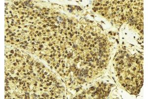 ABIN6276492 at 1/100 staining Human breast cancer tissue by IHC-P. (Cullin 3 Antikörper  (Internal Region))