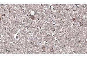 ABIN6277595 at 1/100 staining Human brain cancer tissue by IHC-P. (GDI1 Antikörper  (Internal Region))