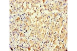 Immunohistochemistry of paraffin-embedded human lung cancer using ABIN7166679 at dilution of 1:100