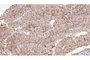ABIN6273304 at 1/100 staining Human thyroid cancer tissue by IHC-P. (RAB14 Antikörper  (C-Term))