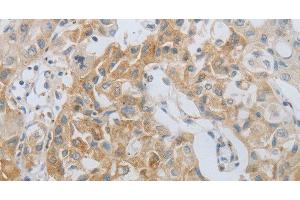 Immunohistochemistry of paraffin-embedded Human lung cancer using MMP25 Polyclonal Antibody at dilution of 1:80