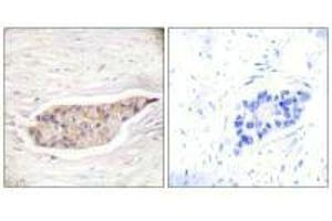 Immunohistochemical analysis of paraffin-embedded human breast carcinoma tissue using Annexin A6 antibody.