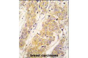 Formalin-fixed and paraffin-embedded human breast carcinoma tissue reacted with PKM2 polyclonal antibody  , which was peroxidase-conjugated to the secondary antibody, followed by DAB staining . (PKM2 Antikörper  (AA 483-513))