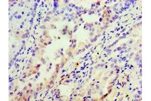 Immunohistochemistry of paraffin-embedded human lung cancer using ABIN7156235 at dilution of 1:100 (INHBA Antikörper  (AA 311-426))