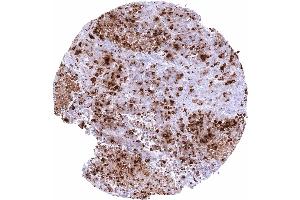 Esophagus Neuroendocrine carcinoma with strong somatostatin immunostaining of tumor cells (Rekombinanter Somatostatin Antikörper)